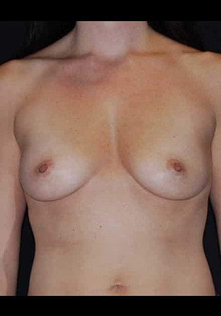 Breast Augmentation Before & After