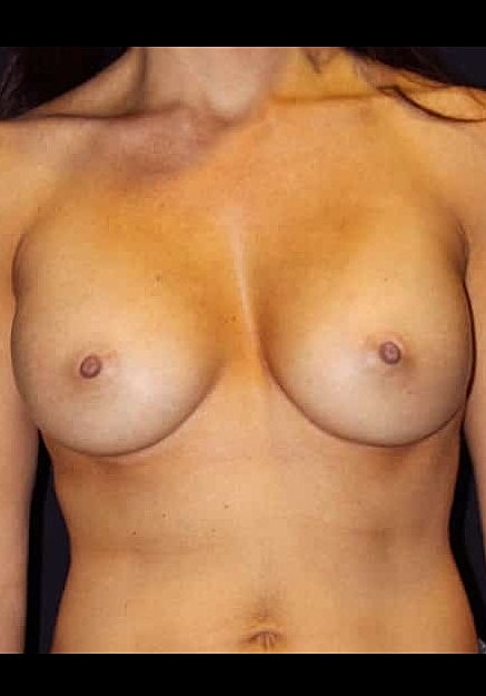 Breast Augmentation Before & After