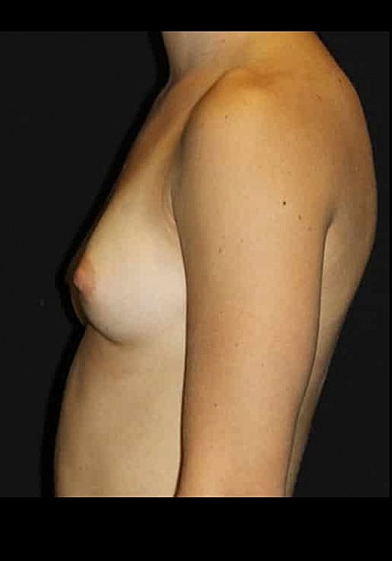Breast Augmentation Before & After