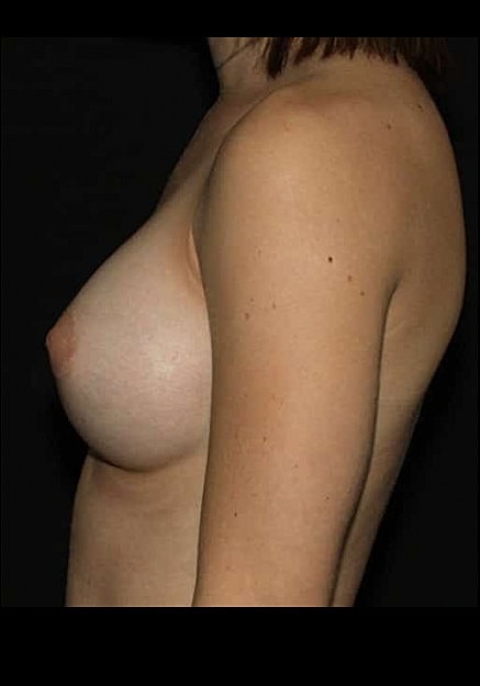 Breast Augmentation Before & After