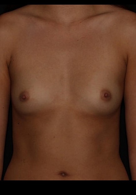Breast Augmentation Before & After