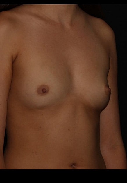 Breast Augmentation Before & After