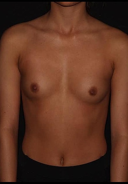 Breast Augmentation Before & After