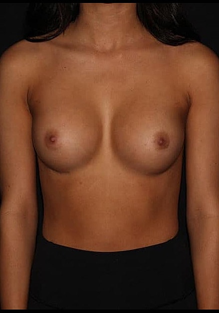 Breast Augmentation Before & After