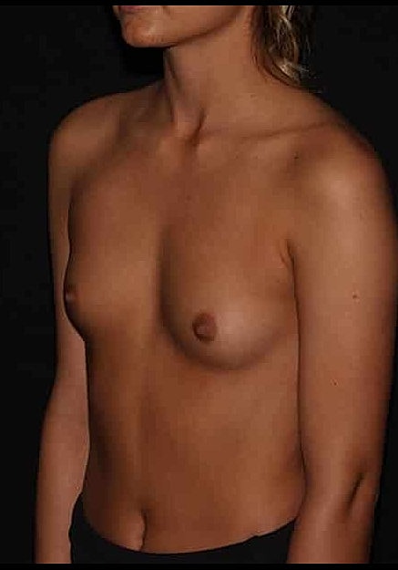Breast Augmentation Before & After