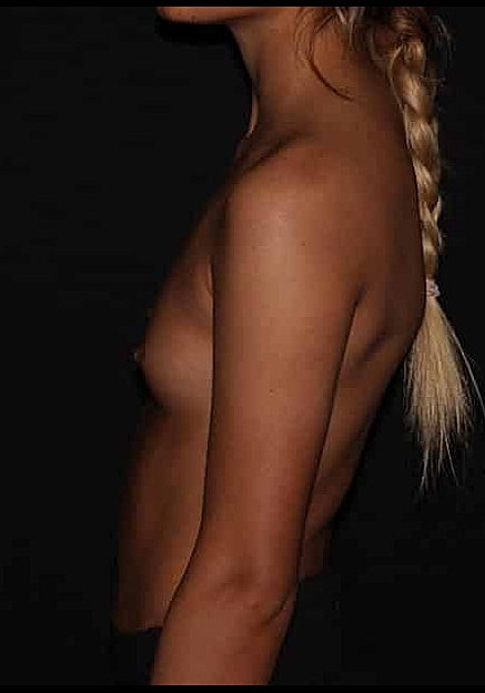 Breast Augmentation Before & After