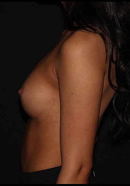 Breast Augmentation Before & After