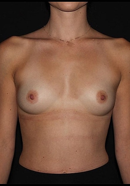 Breast Augmentation Before & After