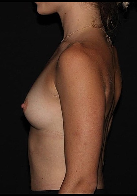 Breast Augmentation Before & After