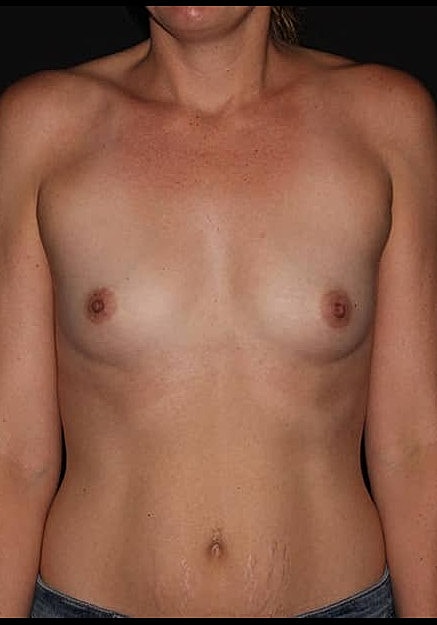 Breast Augmentation Before & After