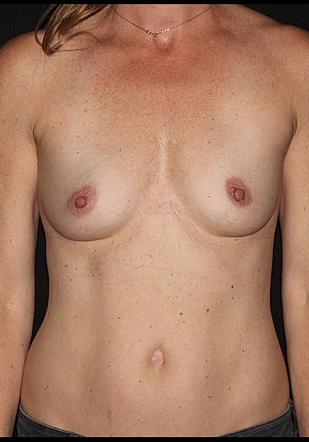Breast Augmentation Before & After