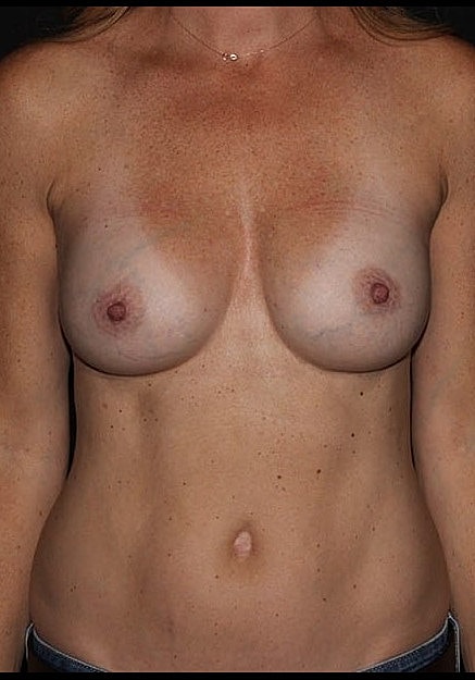 Breast Augmentation Before & After