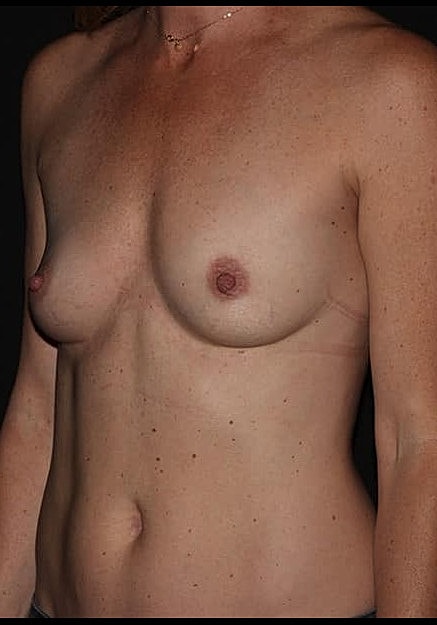 Breast Augmentation Before & After