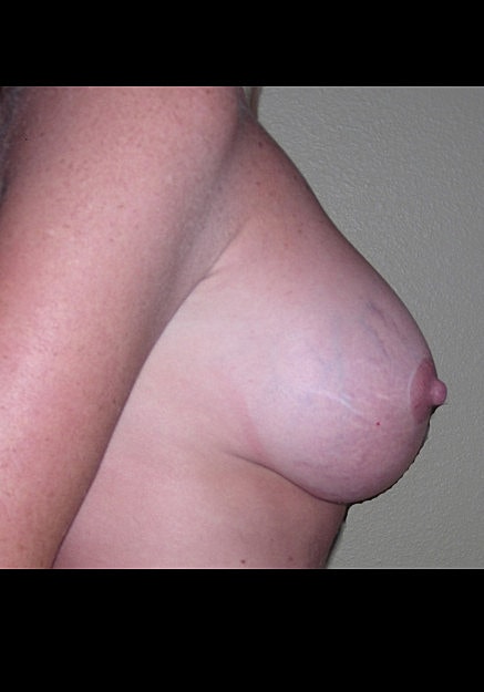 Breast Lift Before & After