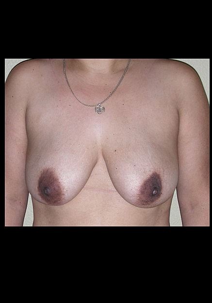 Breast Lift Before & After