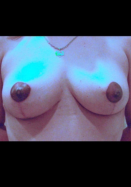 Breast Lift Before & After