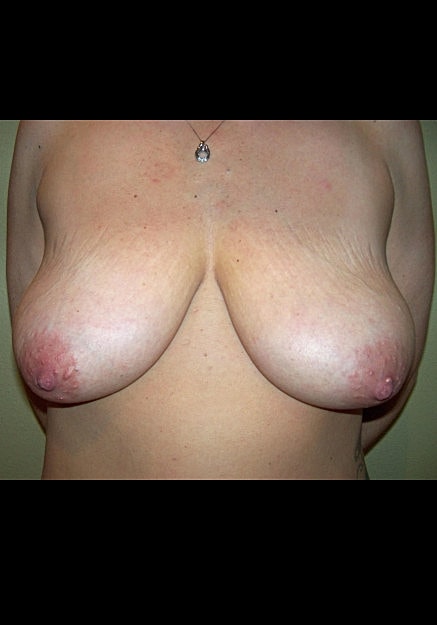 Breast Lift Before & After