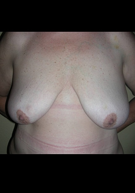 Breast Lift Before & After