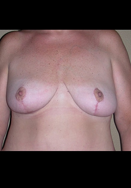 Breast Lift Before & After