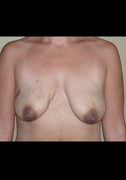 Breast Lift Before & After
