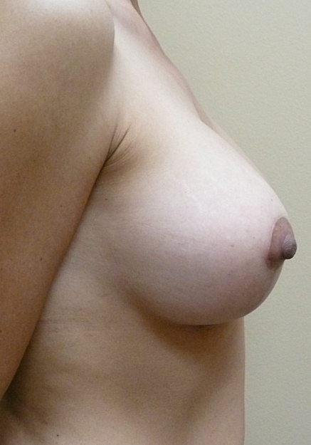Breast Lift Before & After