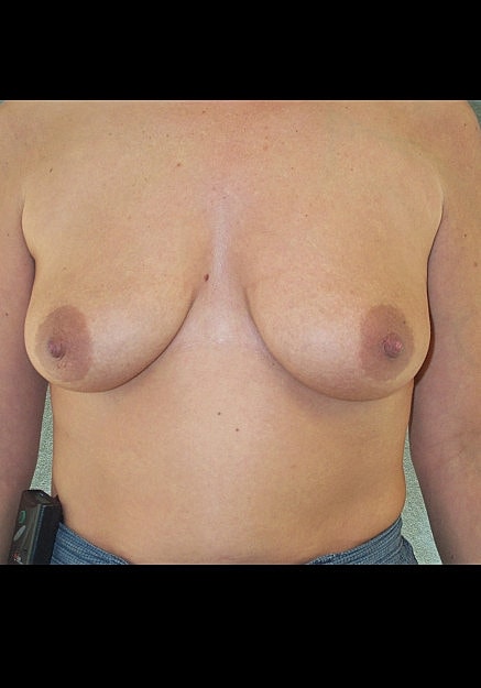 Breast Lift Before & After