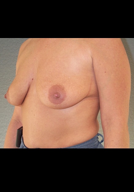 Breast Lift Before & After