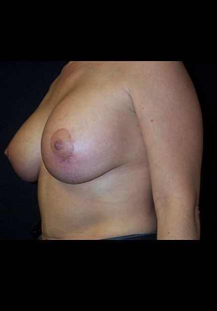 Breast Lift Before & After