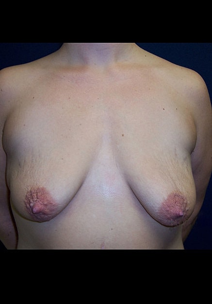 Breast Lift Before & After
