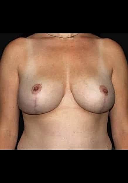 Breast Lift Before & After