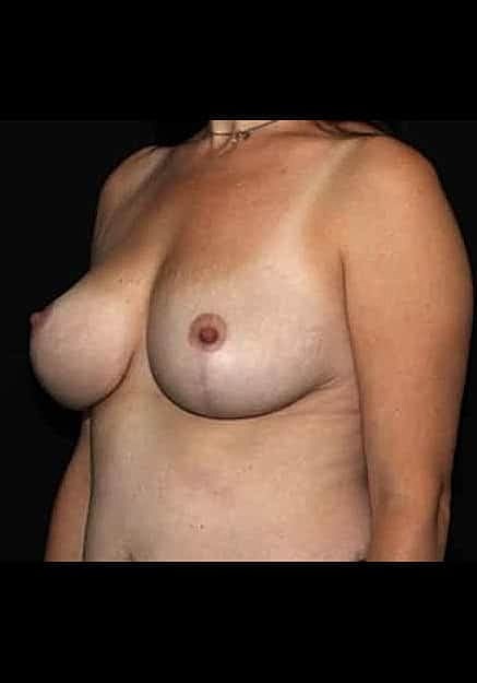 Breast Lift Before & After