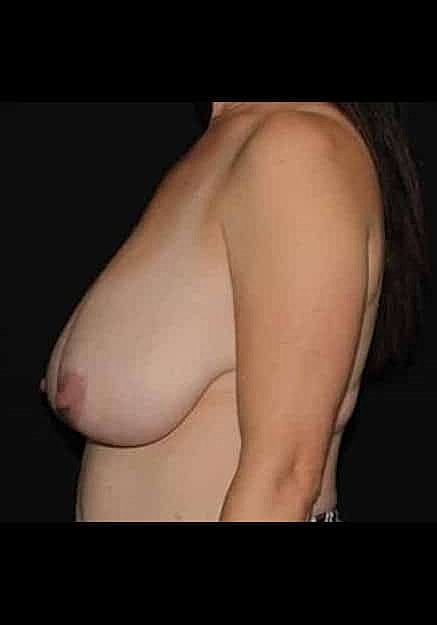 Breast Lift Before & After