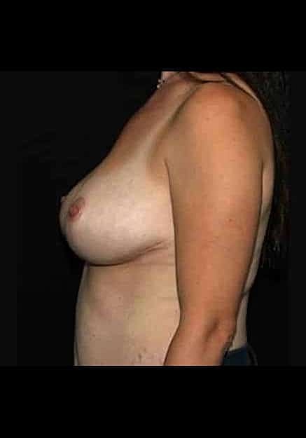 Breast Lift Before & After