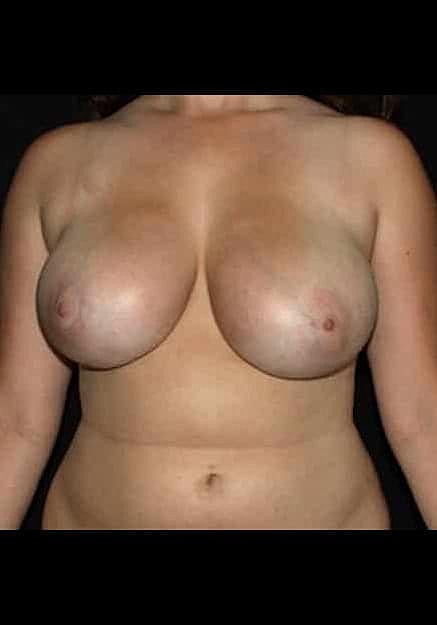 Breast Lift Before & After