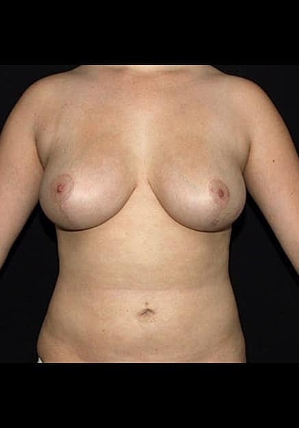 Breast Lift Before & After