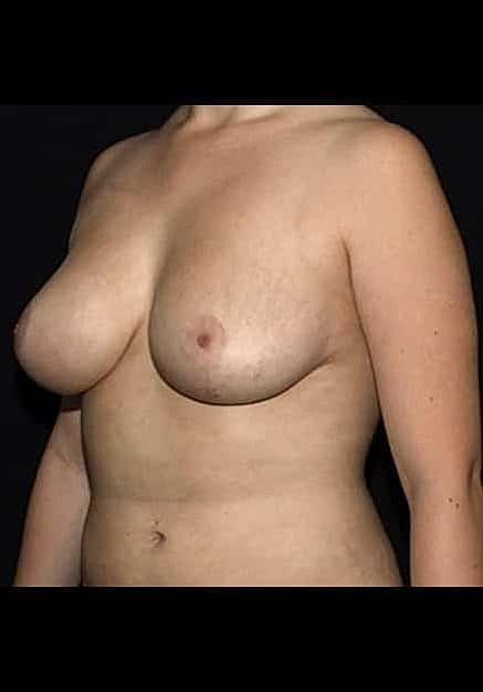 Breast Lift Before & After