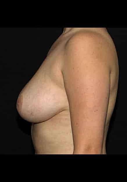 Breast Lift Before & After