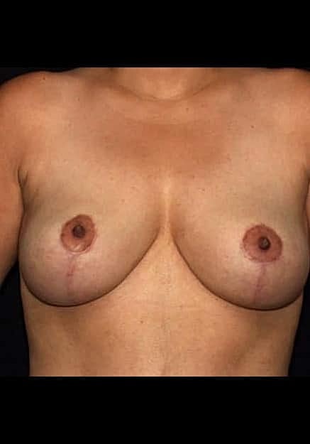 Breast Lift Before & After