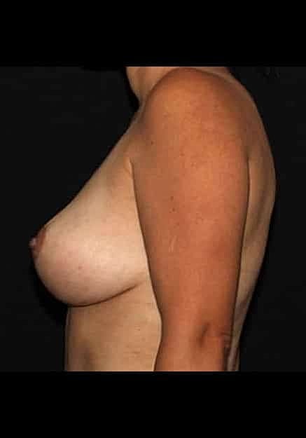 Breast Lift Before & After