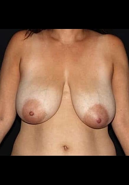 Breast Lift Before & After