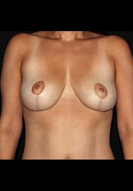 Breast Lift Before & After