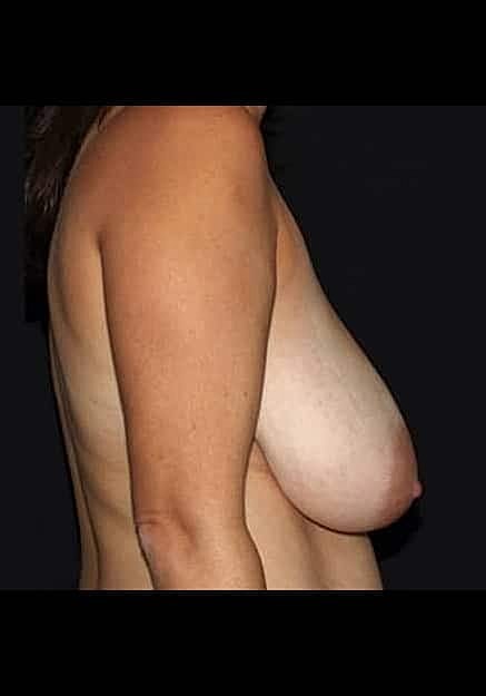 Breast Lift Before & After