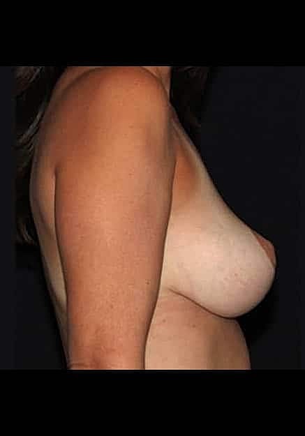 Breast Lift Before & After
