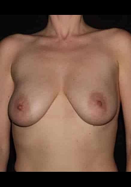 Breast Lift Before & After