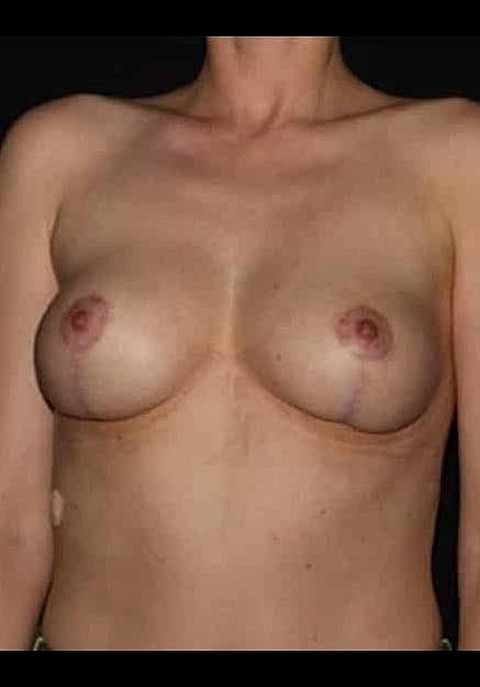 Breast Lift Before & After
