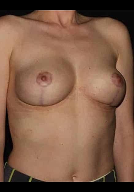 Breast Lift Before & After