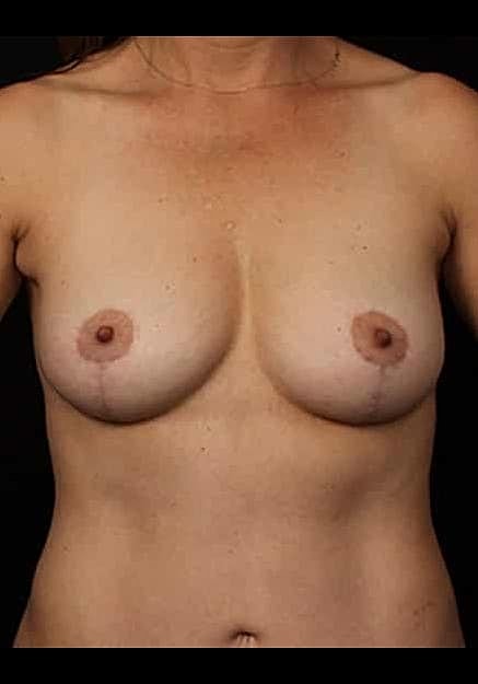 Breast Lift Before & After