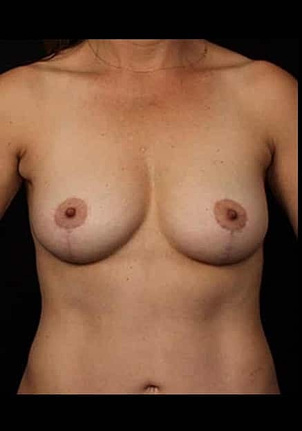 Breast Lift Before & After