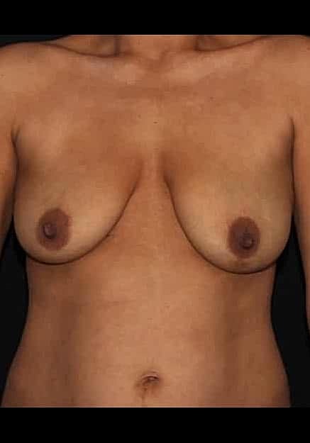 Breast Lift Before & After