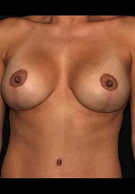 Breast Lift Before & After